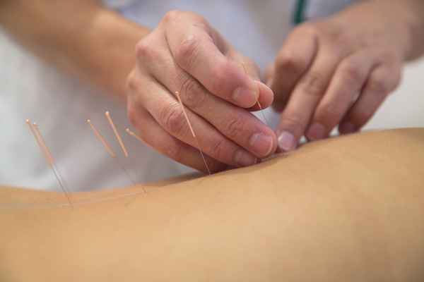 Acupuncture in Glastonbury