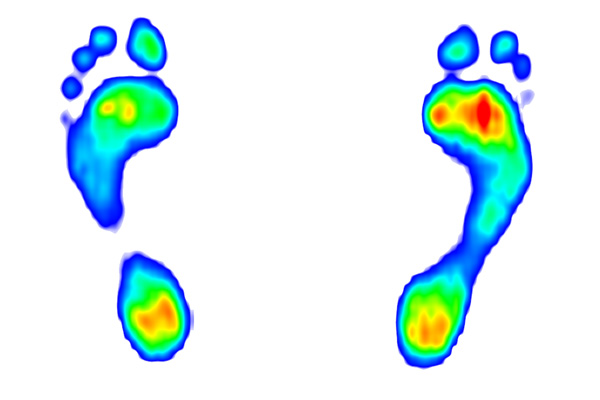 Gait analysis Glastonbury Somerset